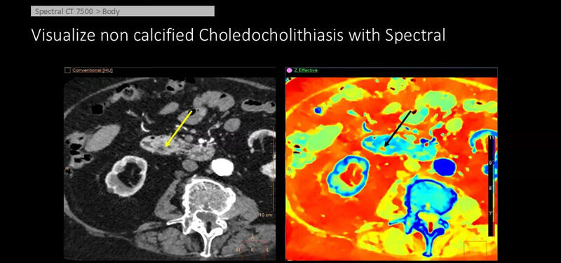 Система компьютерной томографии Philips Spectral CT 7500